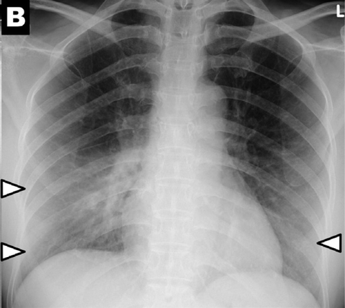 radiol.2020201160.fig2b consolidation