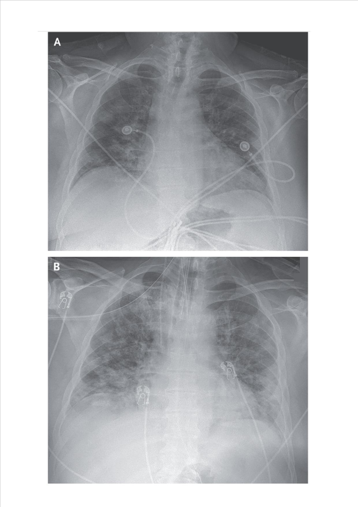 kidney injury and covid