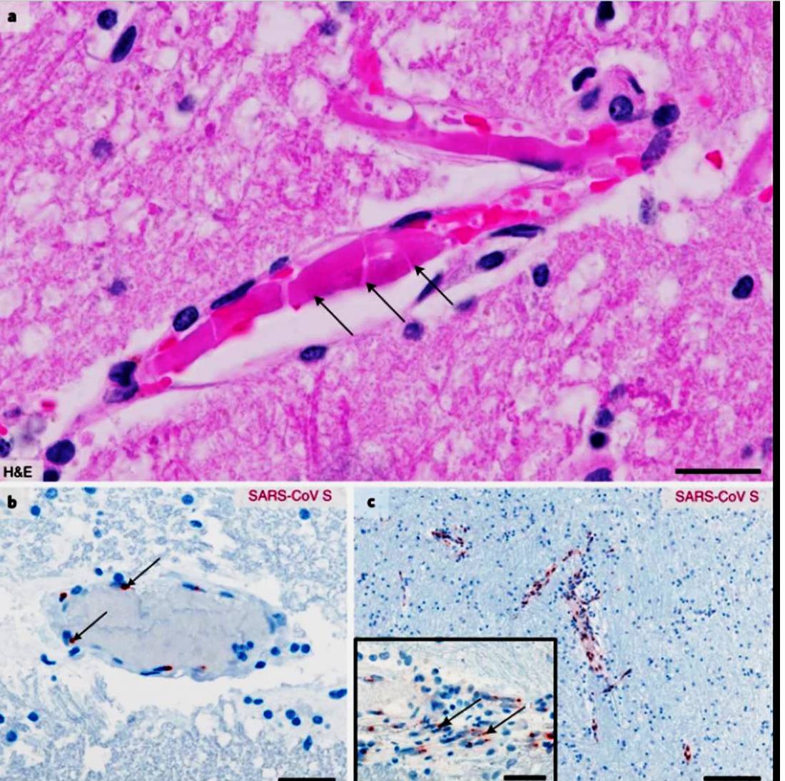 thalamus thrombi